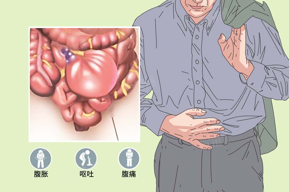 机械性肠梗阻的主要表现