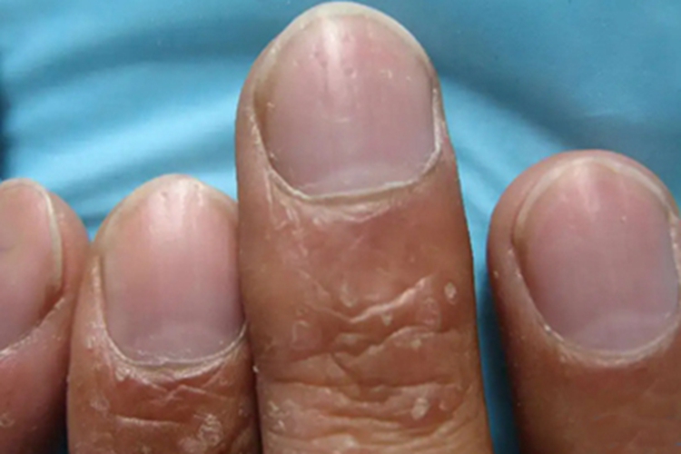 甲凹点中指有几个凹点图