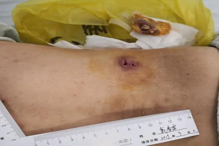 腰大肌深部脓肿穿刺图