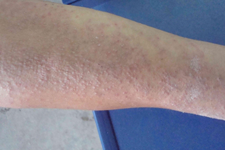 慢性苔藓样角化病小腿疙瘩图 慢性苔藓样角化病小腿疙瘩图