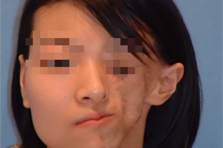 肌肉萎缩面部症状图 肌肉萎缩面部症状图