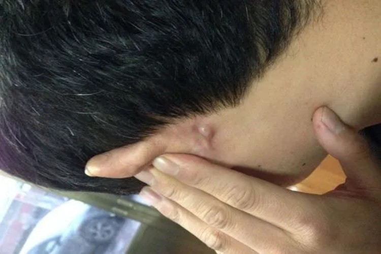 透明细胞汗腺瘤耳周症状图