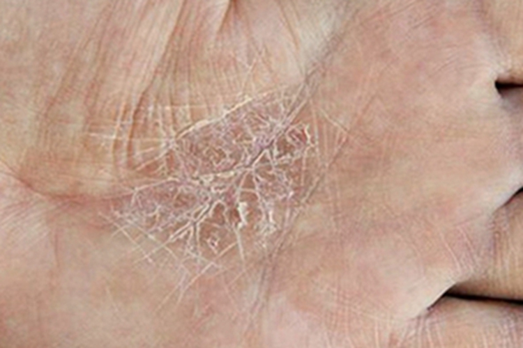 获得性鱼鳞病手掌裂纹图