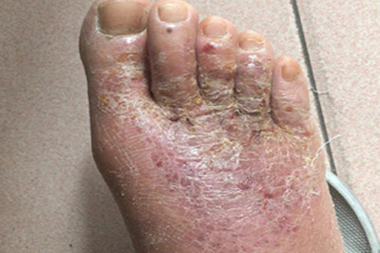 亚急性湿疹皲裂图 亚急性湿疹皲裂图