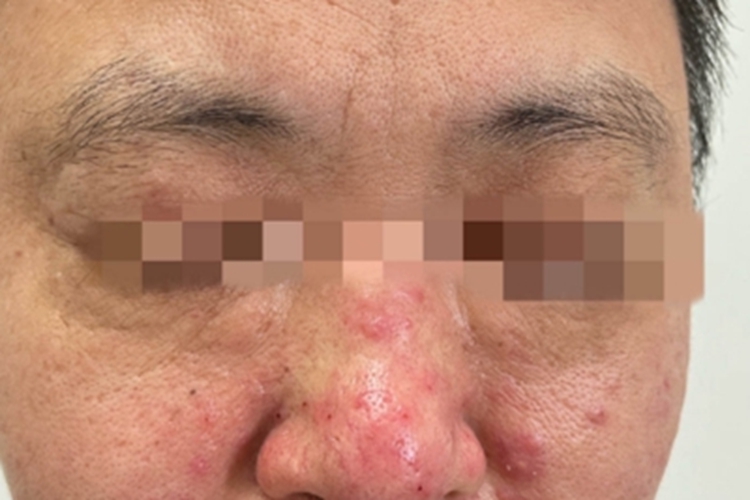 丘疹脓疱型酒糟鼻鼻部丘疹图
