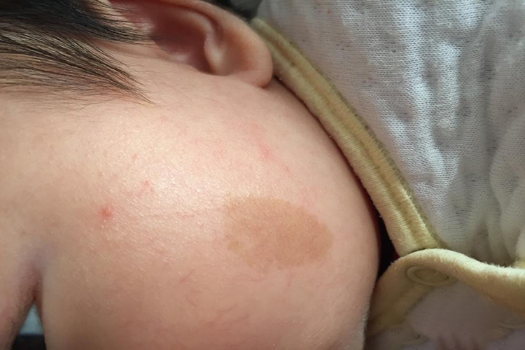 婴儿面部咖啡斑图