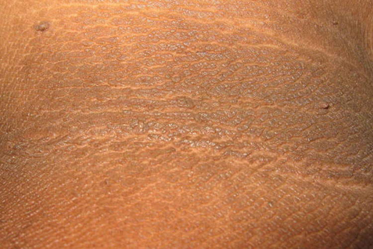 皮损处粗糙肥厚图 皮损处粗糙肥厚图