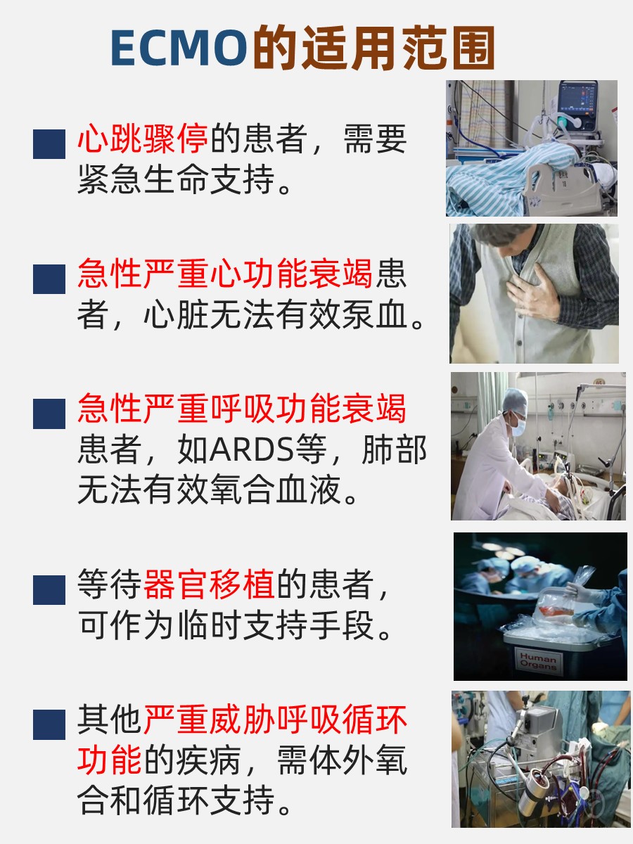 带你认识ECMO：生命线的守护者，不容小觑！