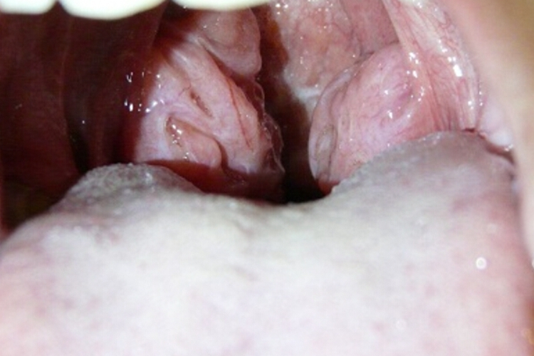 慢性扁桃体炎扁桃体凹凸不平图