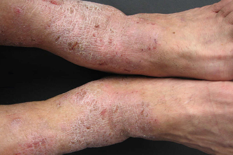 皮肤过敏红肿脚踝脱皮图