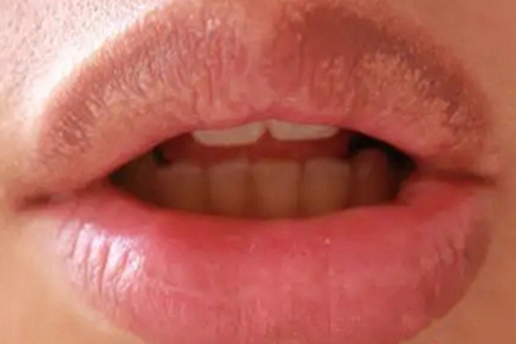 异位皮脂腺嘴唇斑丘疹图