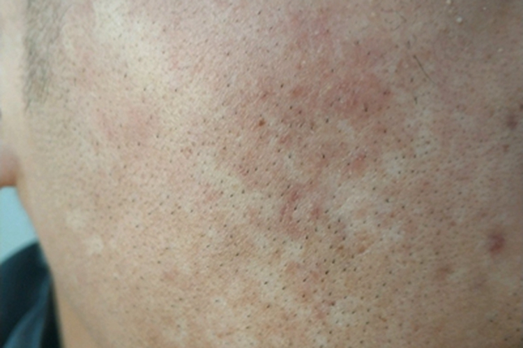 花斑糠疹面部发白图