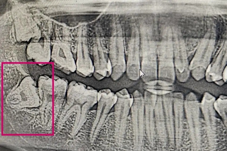 下颌低位阻生智齿图