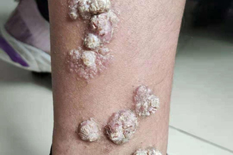 艾滋病期小腿症状图 艾滋病期小腿症状图