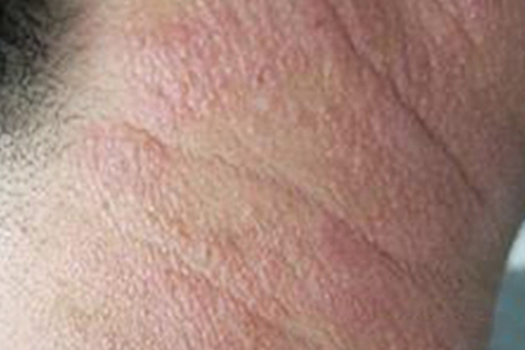 叠瓦癣初期颈部起疹子图