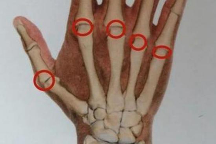 掌指关节图 掌指关节图