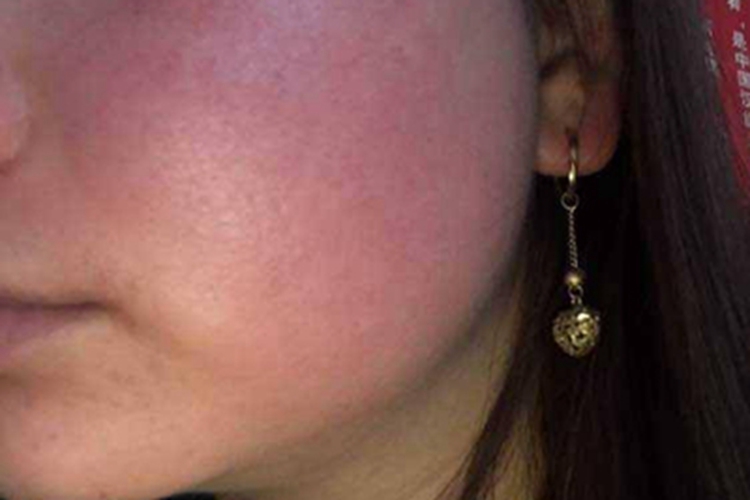 一氧化碳中毒肿图