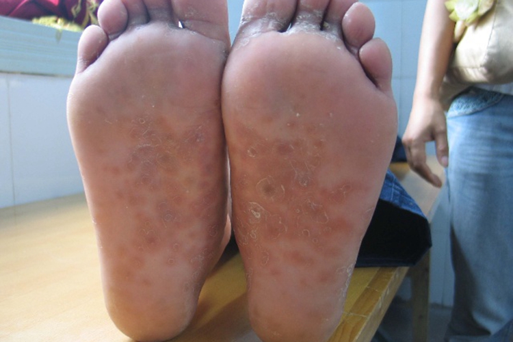 丘疹性梅毒疹图 丘疹性梅毒疹图