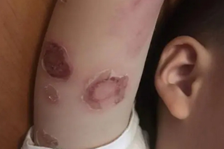 幼年型类天疱疮结痂图