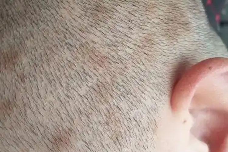 头皮咖啡色斑图 头皮咖啡色斑图