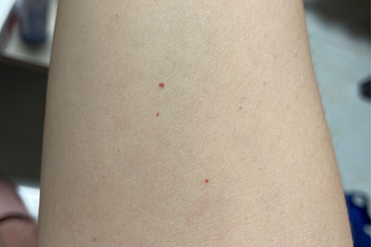 毛细血管瘤红点图 毛细血管瘤红点图