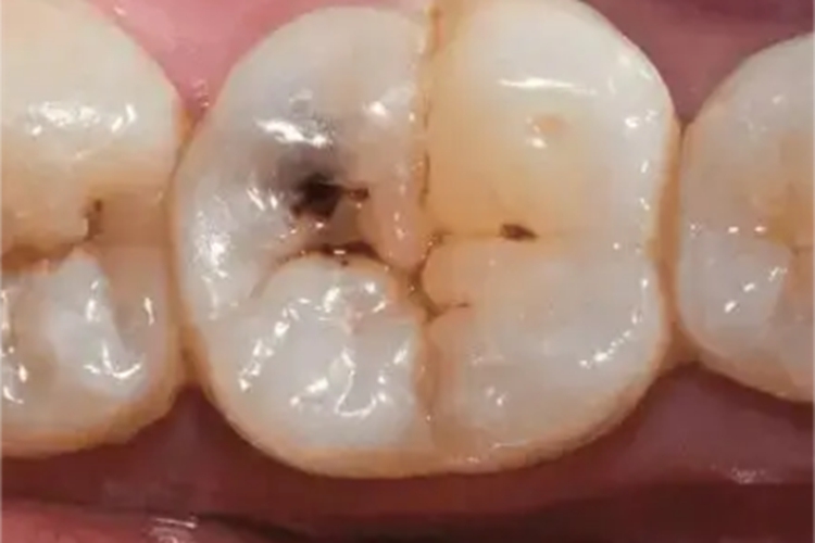 浅龋牙变黑有裂纹图