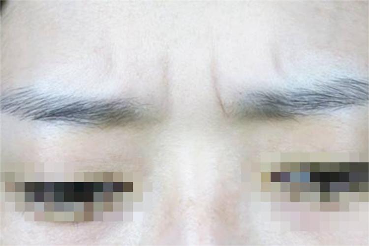 动态性眉间纹图