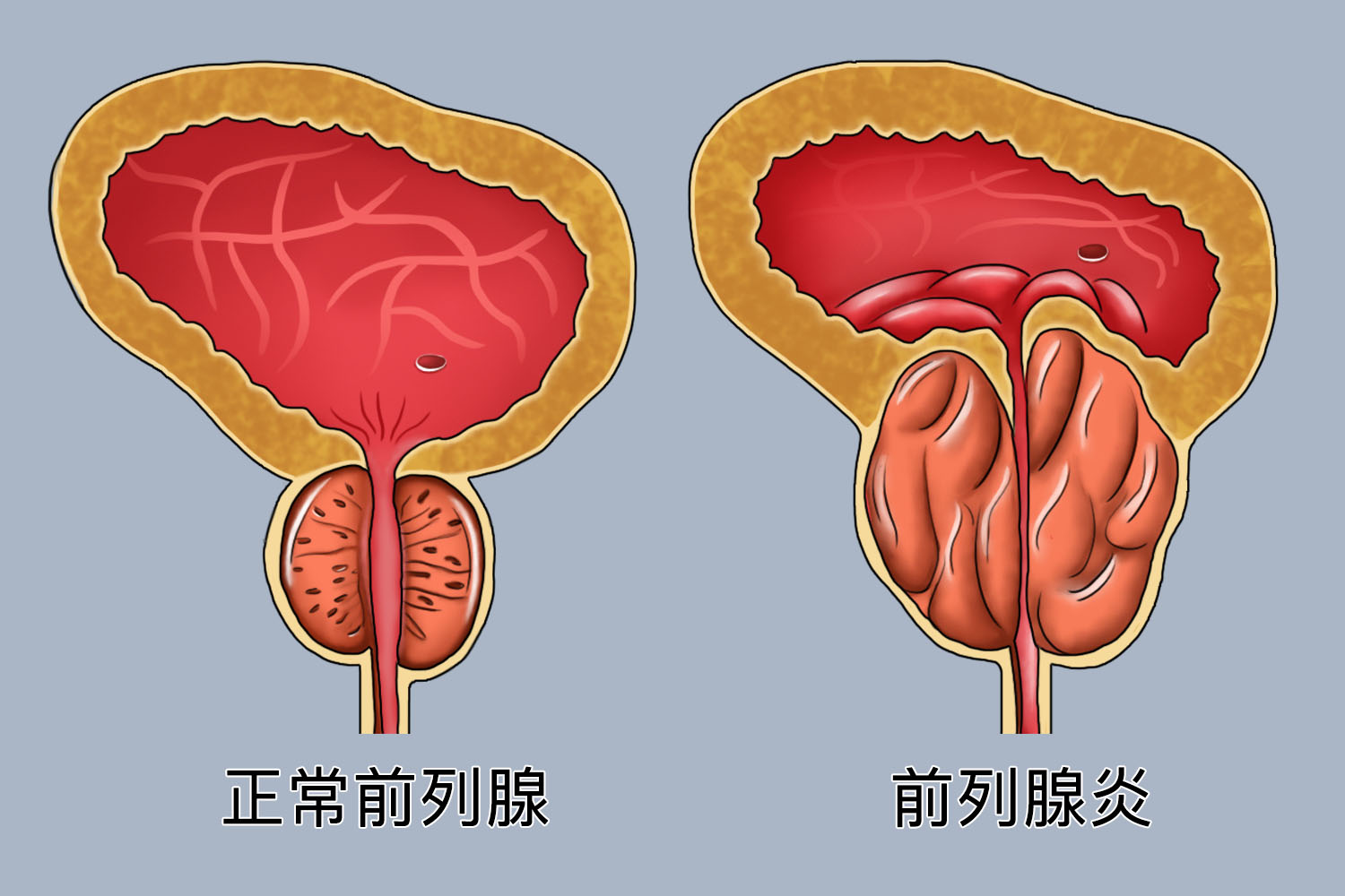 前列腺与前列腺炎对比图