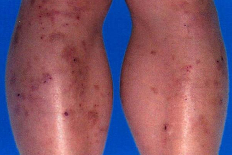 皮肤瘙痒抓后变黑斑图