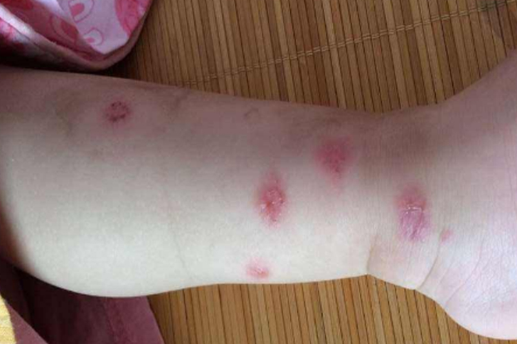 小孩玫瑰糠疹图 小孩玫瑰糠疹图