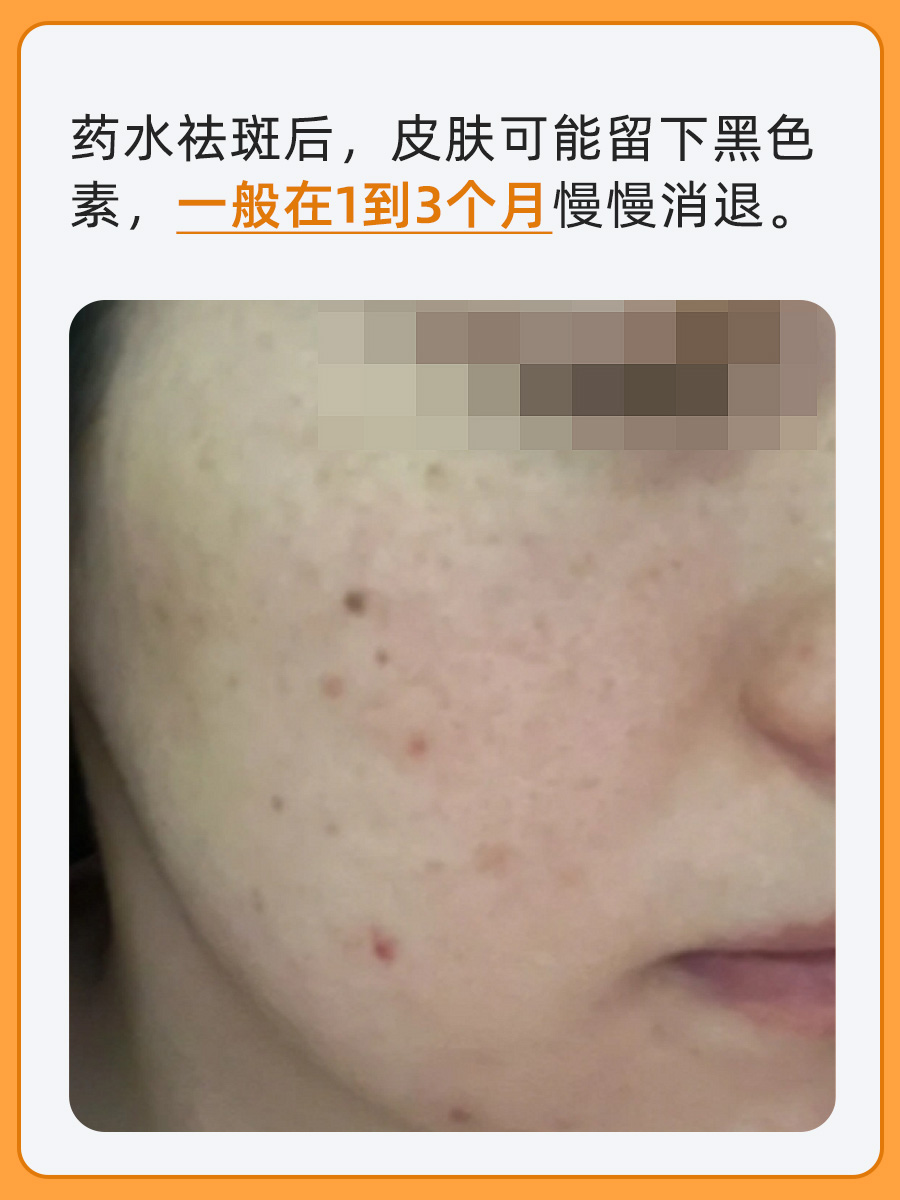 帮你解答！药水点斑留下的黑色素多久能消？
