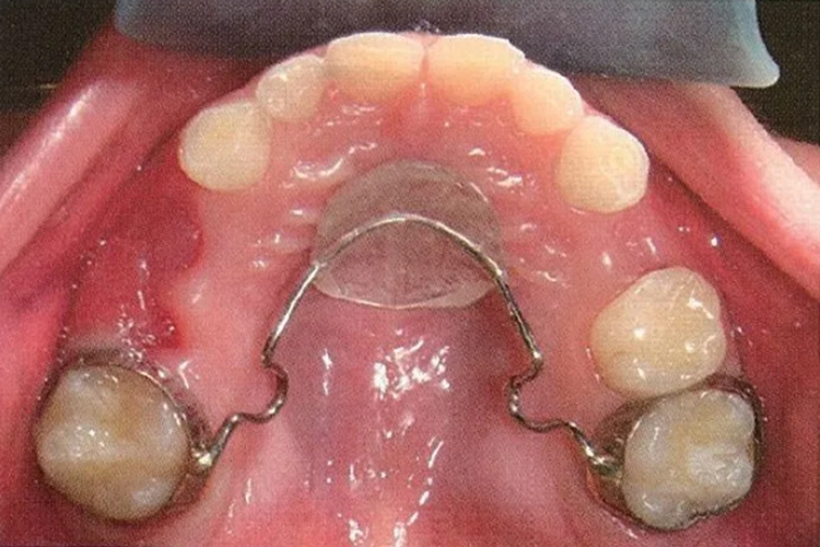 Nance弓间隙保持器图