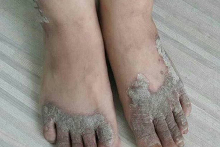 可变性红斑角化病脚部脱屑图 可变性红斑角化病脚部脱屑图