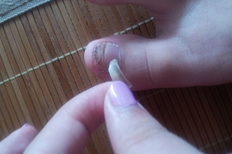 先天性角化不良脚趾甲症状图