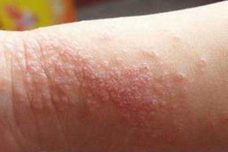 宝宝手臂亚急性湿疹图