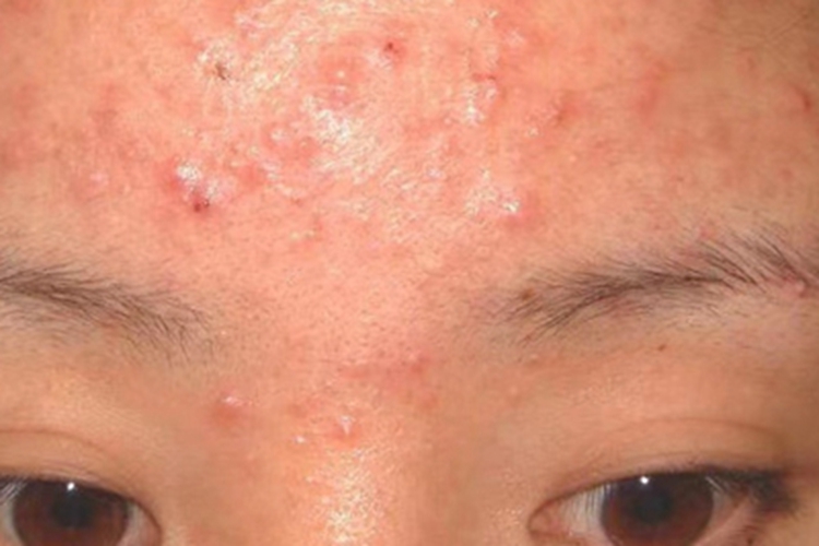 马拉色菌毛囊炎前额皮肤粗糙图