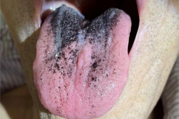 毛舌舌头上有黑色的毛图 毛舌舌头上有黑色的毛图