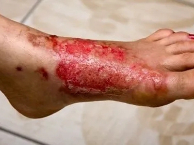 急性网状淋巴管炎的症状和图片 - 有来医生