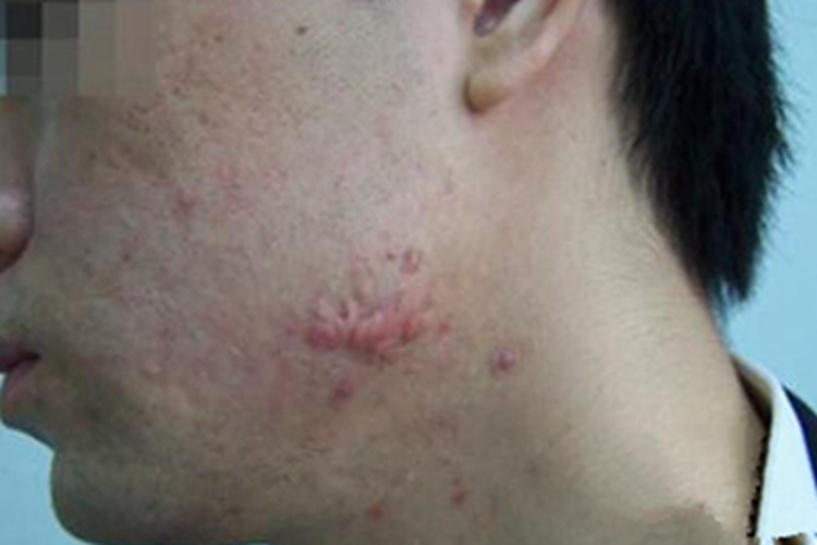 痤疮左脸长大红疙瘩图