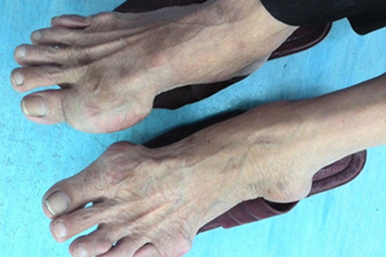 费尔蒂综合征骨畸形症状图 费尔蒂综合征骨畸形症状图