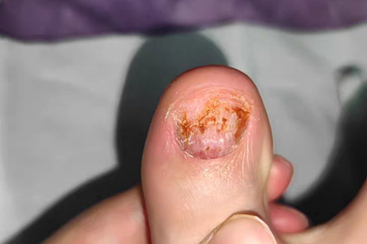全甲损毁型甲真菌病脚趾甲缺损图