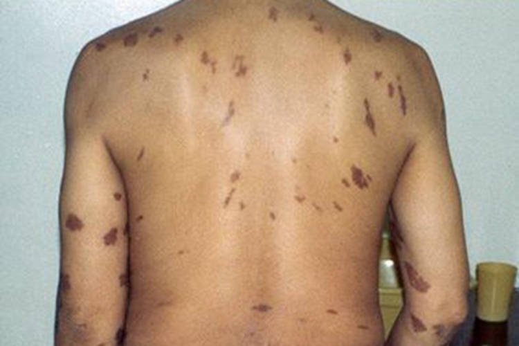 卡波西肉瘤背部长斑图