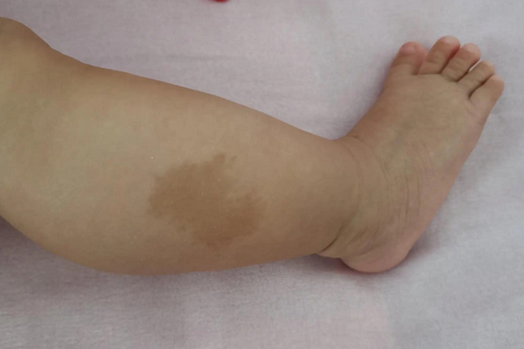 腿部黑色素沉着蒙古斑图