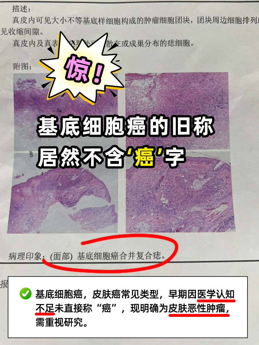 惊！基底细胞癌的旧称居然不含‘癌’字