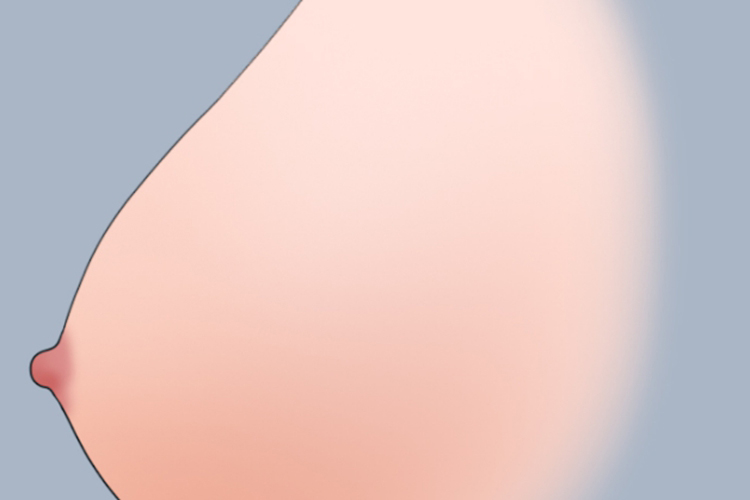 怀孕早期乳房增大图