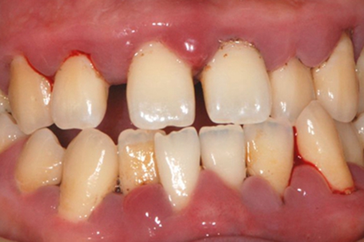 急性坏死性龈口炎牙龈充血图