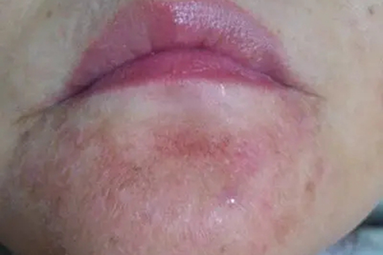 口周皮炎下巴皮肤粗糙图