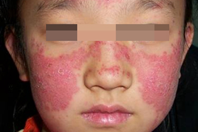 可变性红斑角化病面部粗糙图