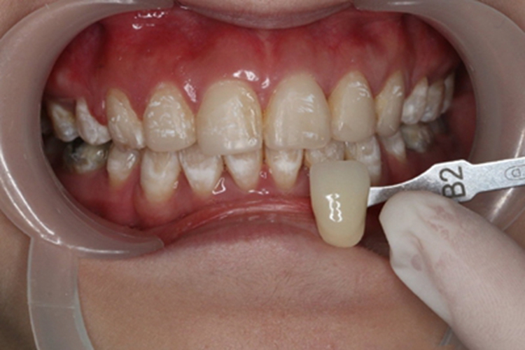 氟斑牙牙齿表面有白斑发黄图