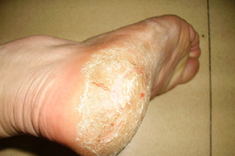 手足癣图